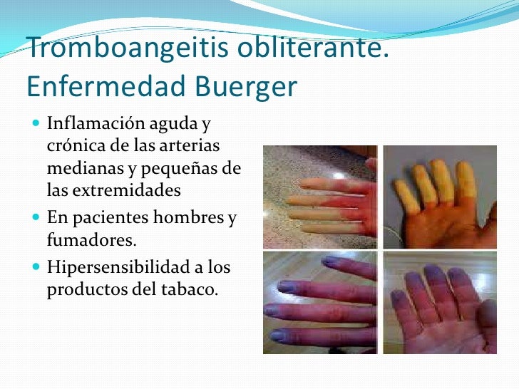enfermedad buerger tromboangeitis obliterante